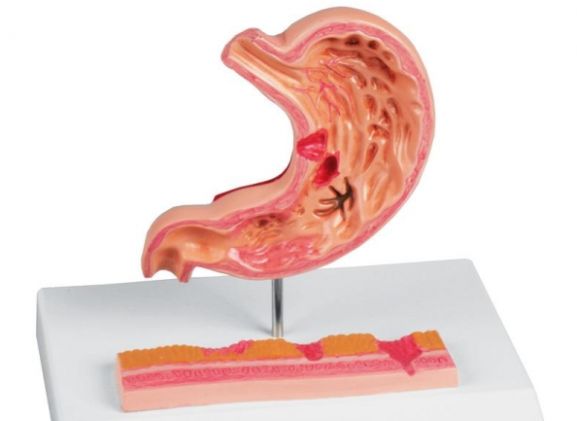 https://mail.jayakelana.co.id/uploads/product/-k217-stomach-with-ulcers-69392f48960fe9e_cover.jpg