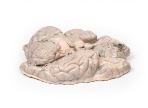 https://mail.jayakelana.co.id/uploads/product/-mp2004-meningioma-6961502fd874c81_cover.jpg