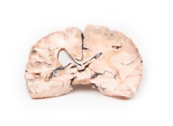 https://mail.jayakelana.co.id/uploads/product/-mp2005-left-cerebral-infarct-79391d7c5ffe427_cover.jpg
