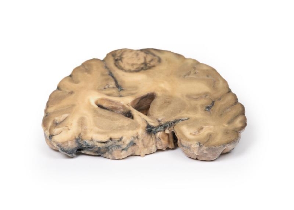 (MP2007) Metastatic Adenocarcinoma in the Brain